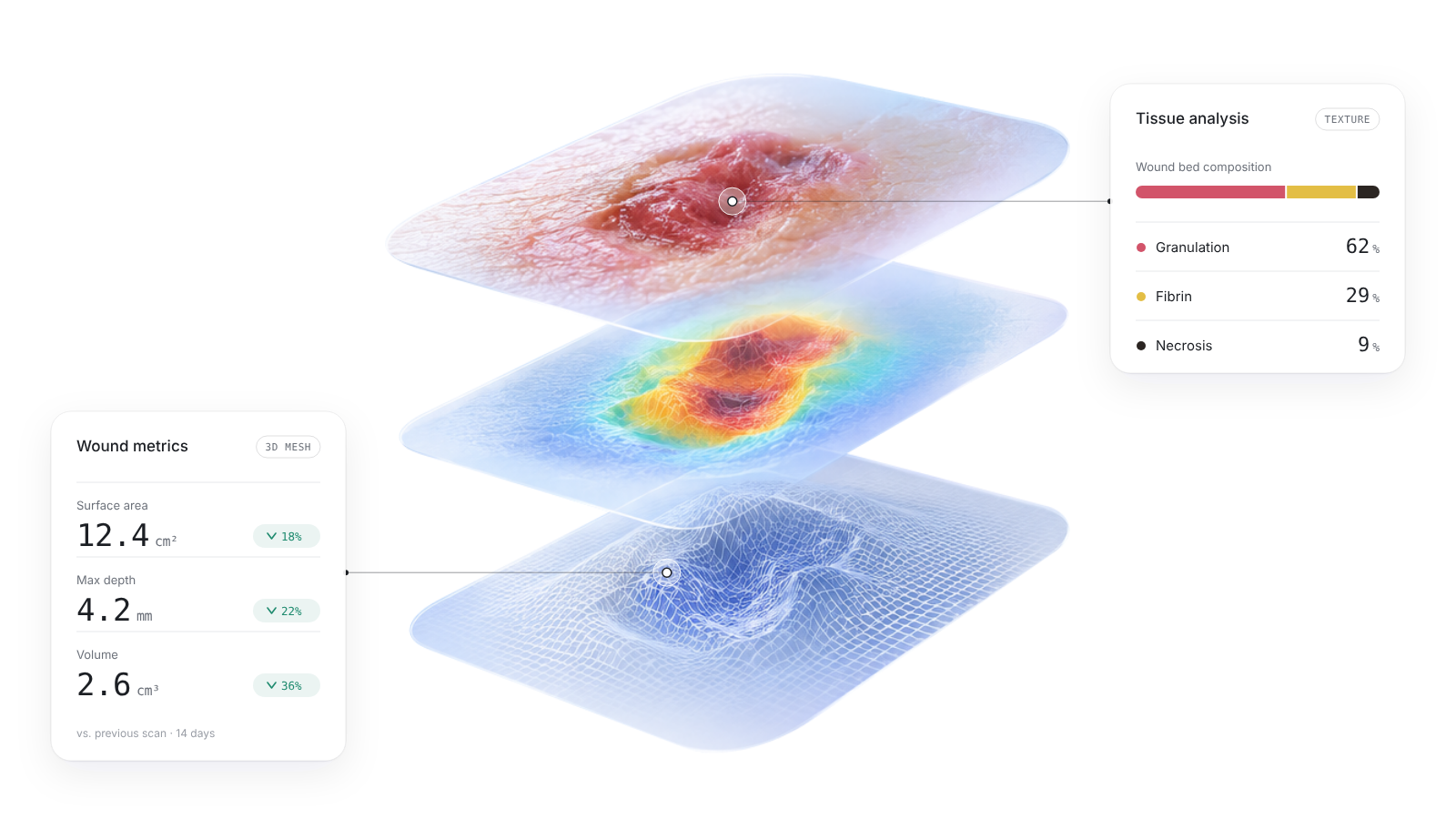TwinSkin AI analysis of a wound: the photographed skin area is reconstructed as a 3D mesh, mapped as a depth heatmap, and classified into granulation, fibrin and necrosis, with surface, depth and volume compared against the previous scan