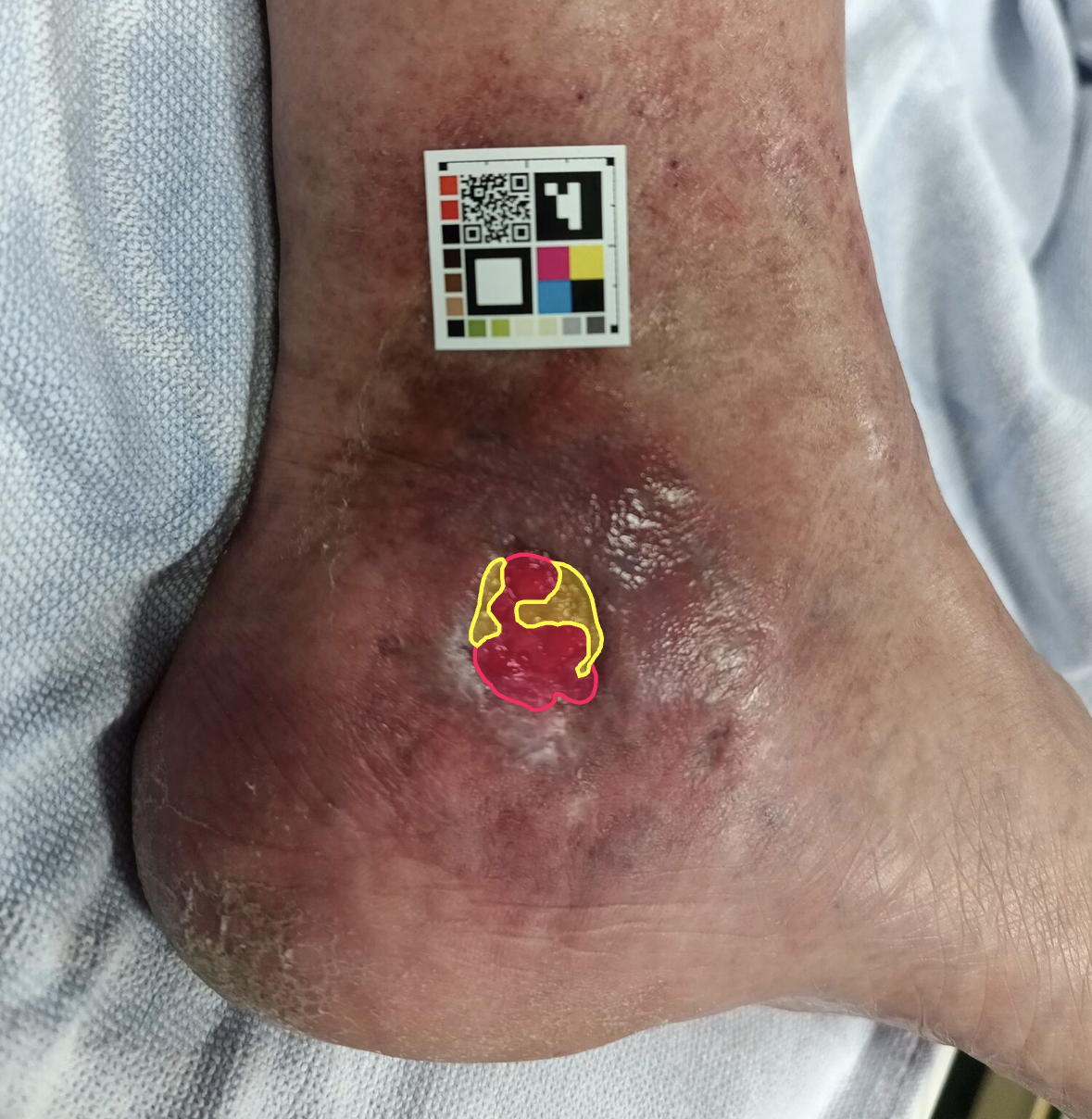 Wound capture at D+63