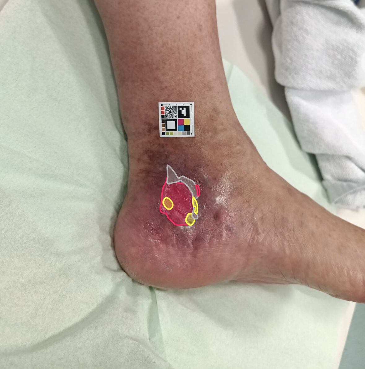 Wound capture at D+0