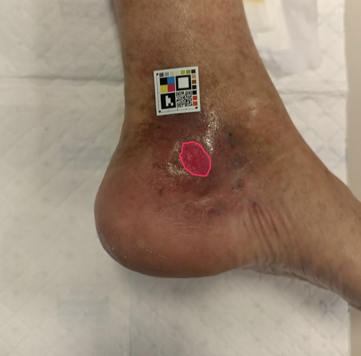 Wound capture at D+85