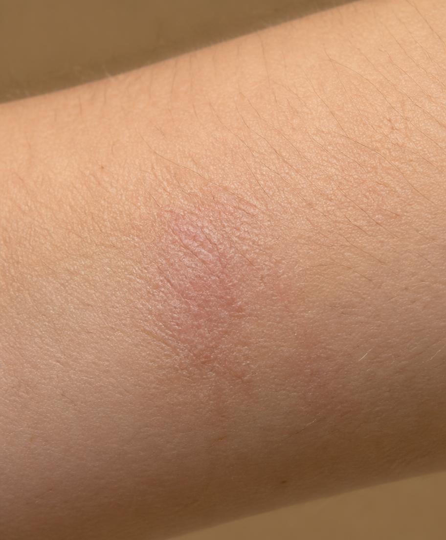 Skin capture at D+12 with the Eczema area outlined