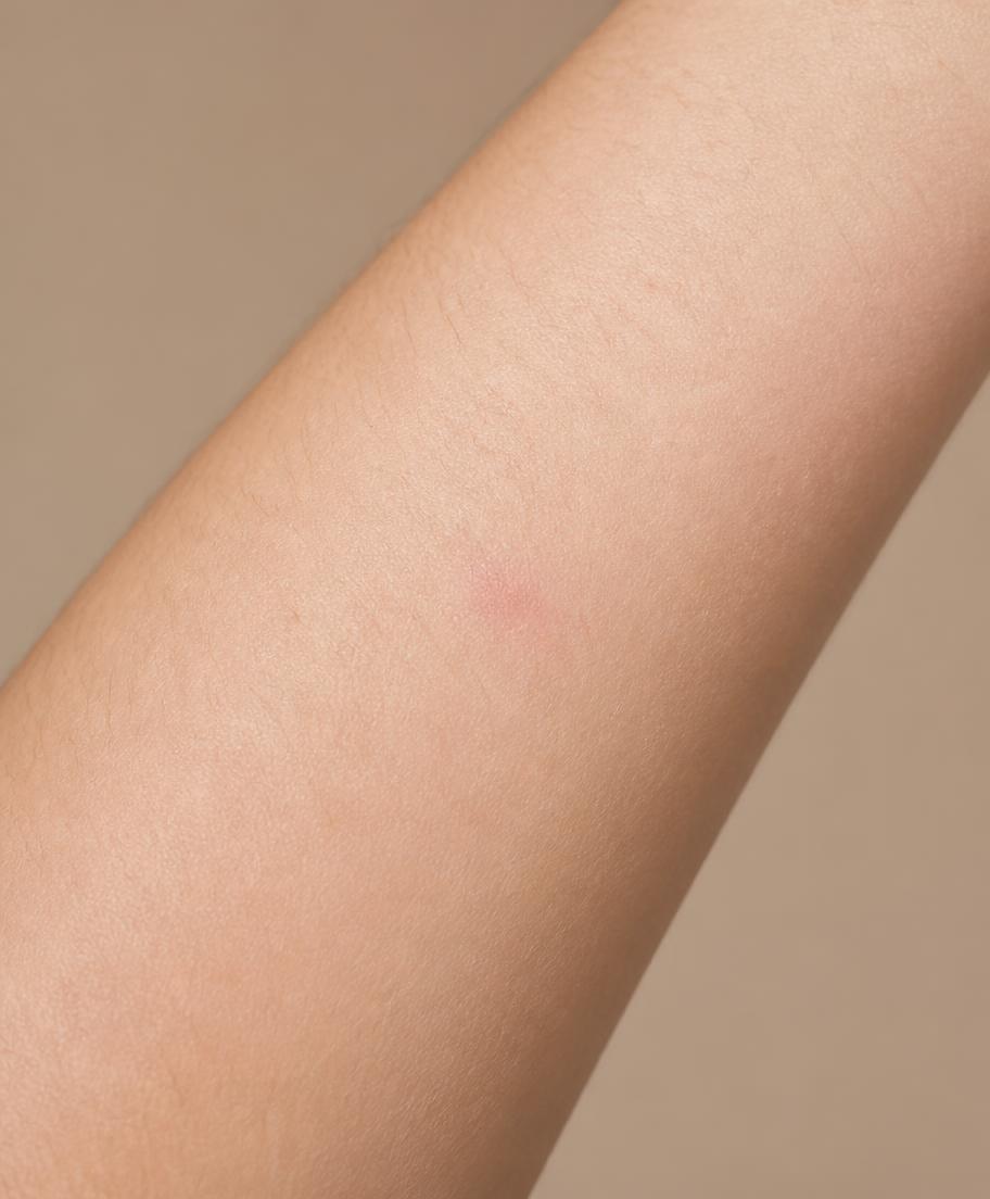 Skin capture at D+18 with the Eczema area outlined